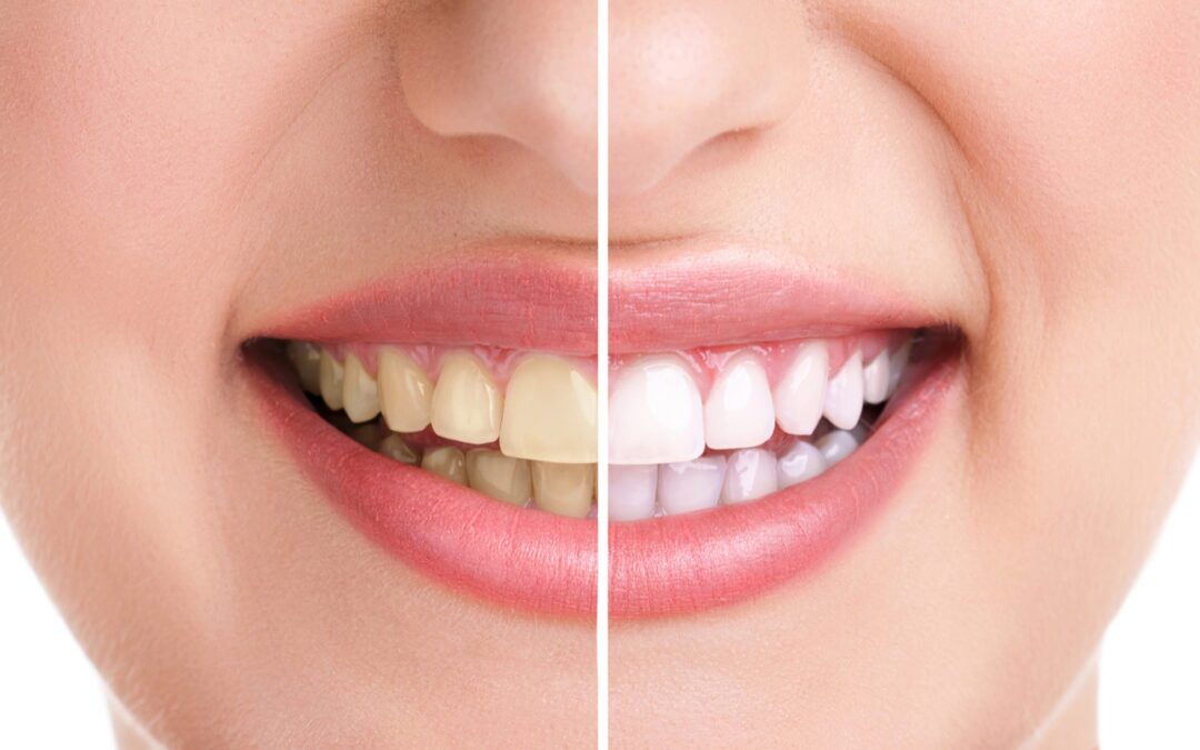 Zoom Whitening Vs Regular Whitening